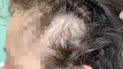 La zona de la cabeza donde le arrancaron el cabello a la funcionaria. Foto: cedida