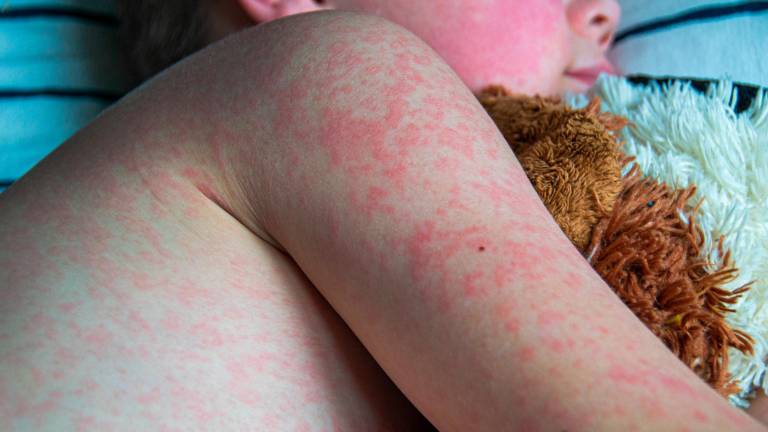 Un niño con sarampión. Foto: Getty Images