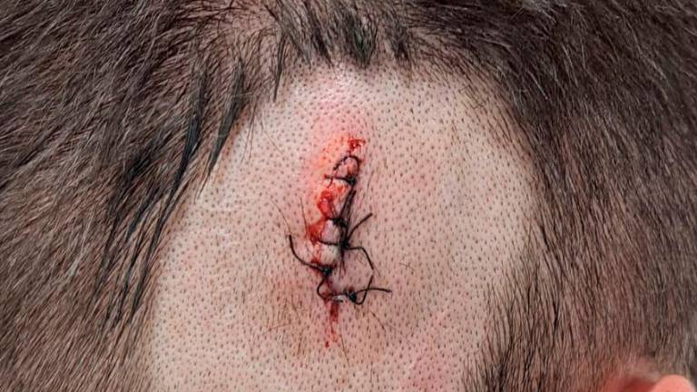 Uno de los funcionarios ha recibido 6 puntos de sutura en la cabeza. Foto: cedida
